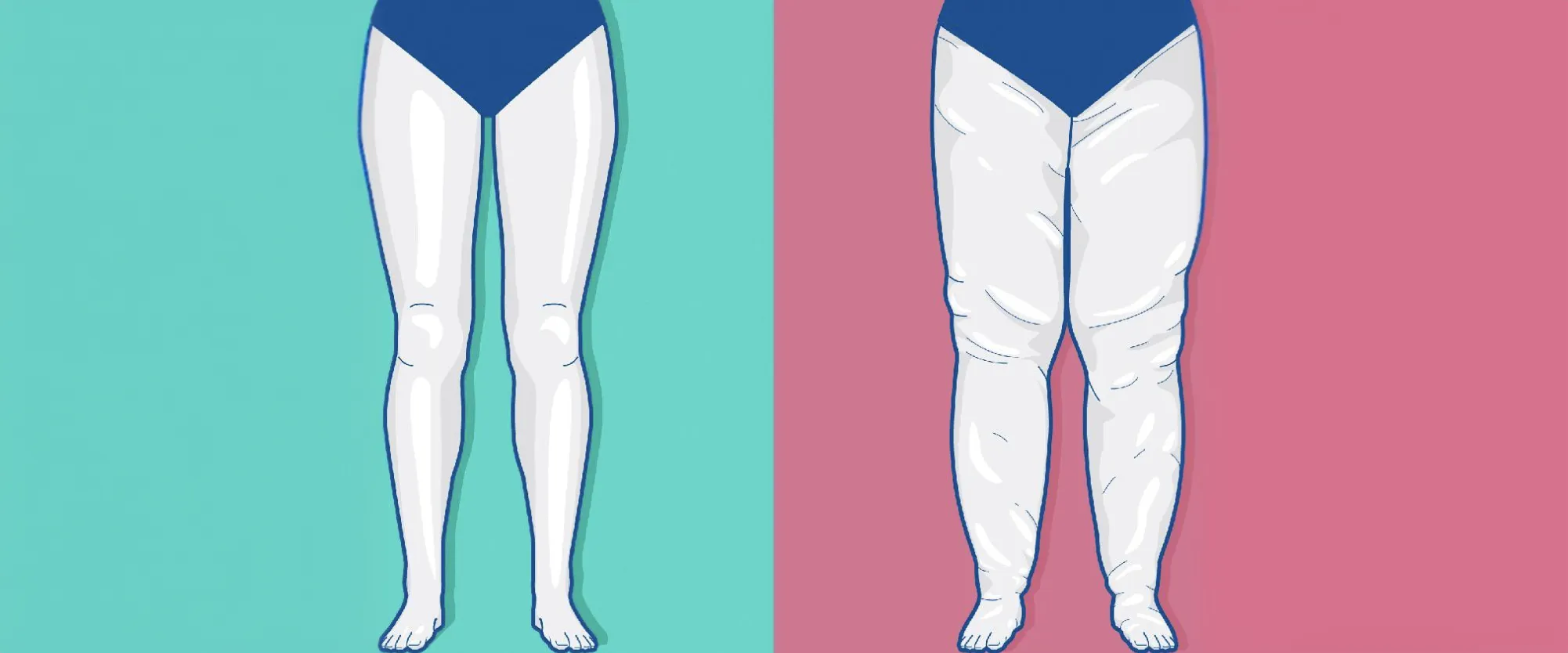Lipedema